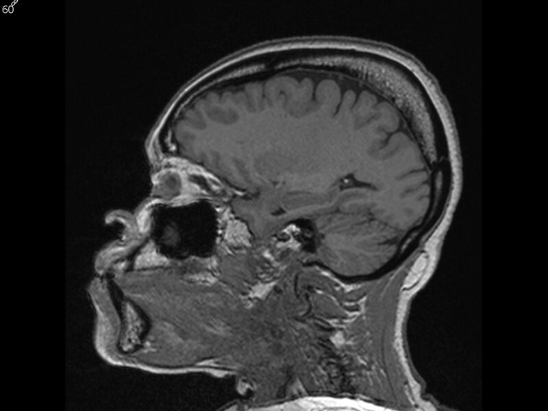 File:Atypical meningioma - intraosseous (Radiopaedia 64915-74572 Sagittal T1 60).jpg