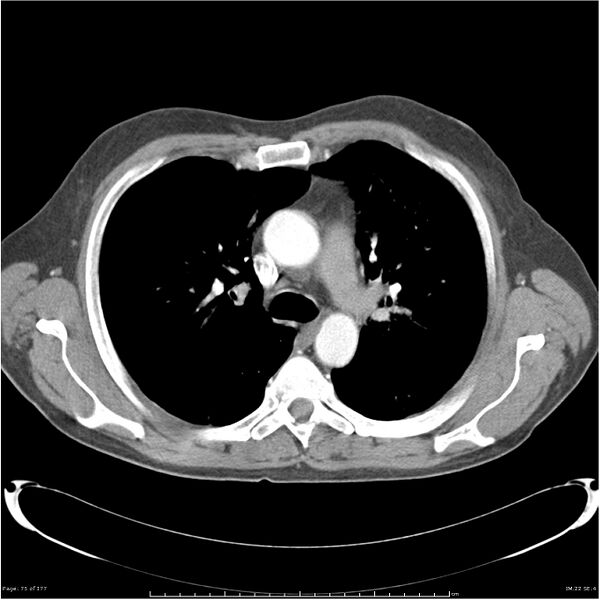 File:Atypical pneumonia - Q fever (Radiopaedia 21993-21989 C+ arterial phase 17).jpg
