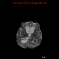 Atypical teratoid rhabdoid tumor (Radiopaedia 10712-11183 Axial DWI 8).jpg