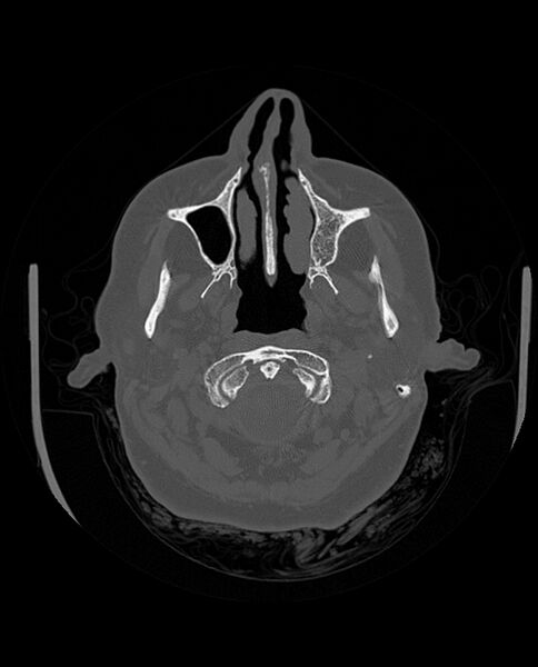 File:Automastoidectomy with labyrinthine fistula (Radiopaedia 84143-99411 Axial non-contrast 47).jpg