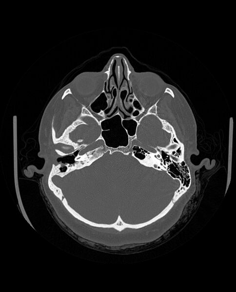 File:Automastoidectomy with labyrinthine fistula (Radiopaedia 84143-99411 Axial non-contrast 84).jpg