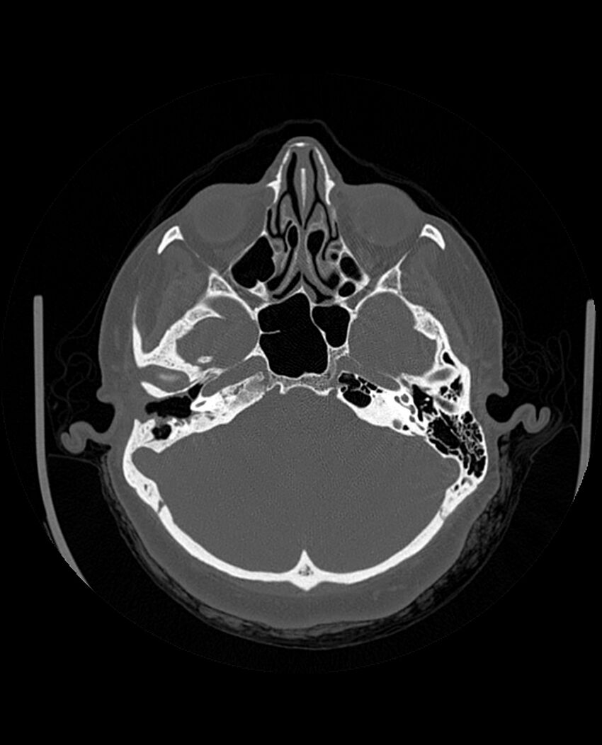 Automastoidectomy with labyrinthine fistula (Radiopaedia 84143-99411 Axial non-contrast 84).jpg