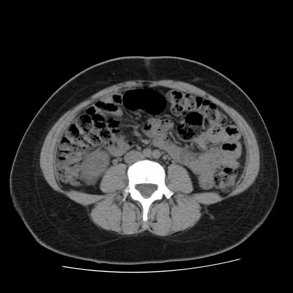 File:Autosomal dominant polycystic kidney disease (Radiopaedia 23061-23093 Axial non-contrast 39).jpg