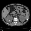 Autosomal dominant polycystic kidney disease (Radiopaedia 36539-38101 Axial non-contrast 30).jpg