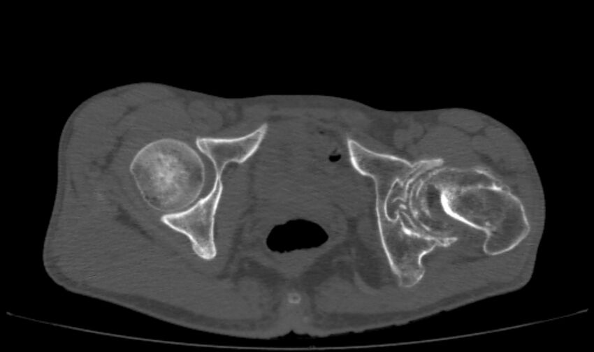 Avascular necrosis of the left hip (Radiopaedia 75068-86125 Axial bone window 61).jpg