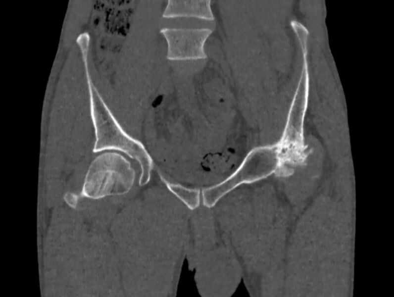 File:Avascular necrosis of the left hip (Radiopaedia 75068-86125 Coronal bone window 10).jpg