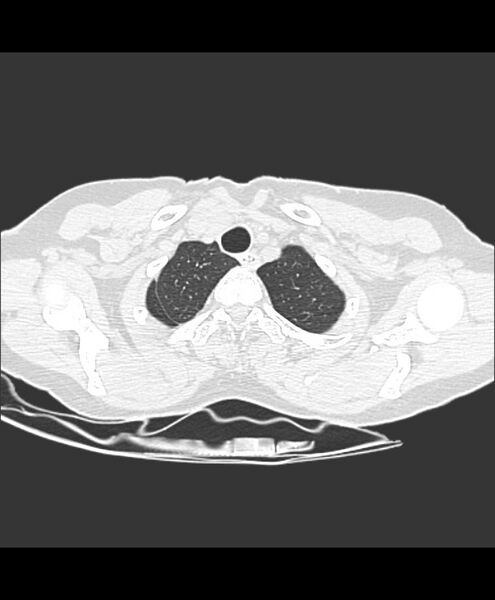 File:Azygos fissure and azygos lobe (Radiopaedia 41841-44832 Axial lung window 32).jpg