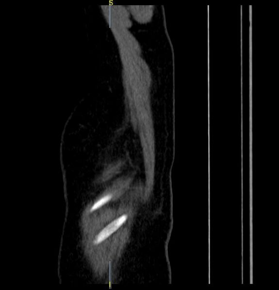 File:Azygos vein aneurysm (Radiopaedia 77824-90130 D 1).JPG