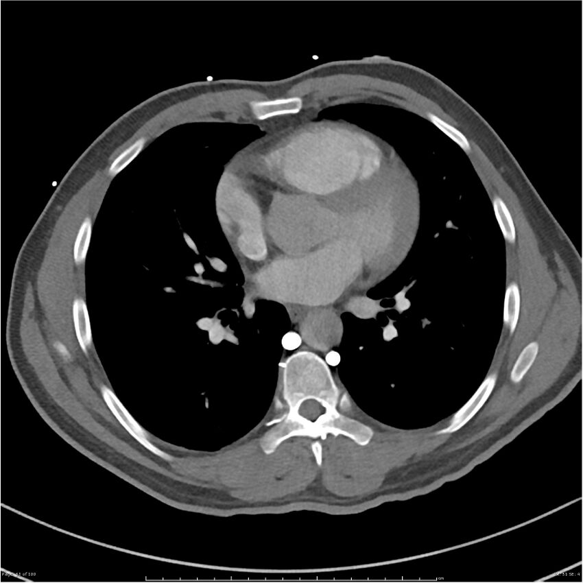 Azygos venous system anatomy (CT pulmonary angiography) (Radiopaedia 25928-26077 Axial C+ CTPA 51).jpg