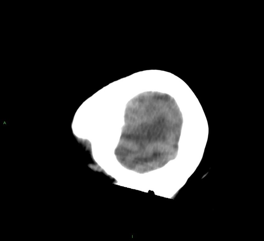 Basal ganglia hemorrhage (Radiopaedia 58759-65981 C 56).jpg