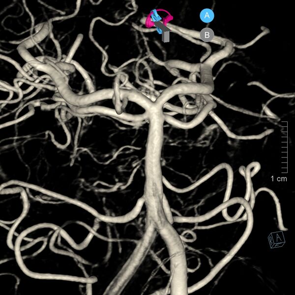 File:Basilar artery perforator aneurysm (Radiopaedia 82455-97734 3D view left VA 47).jpg