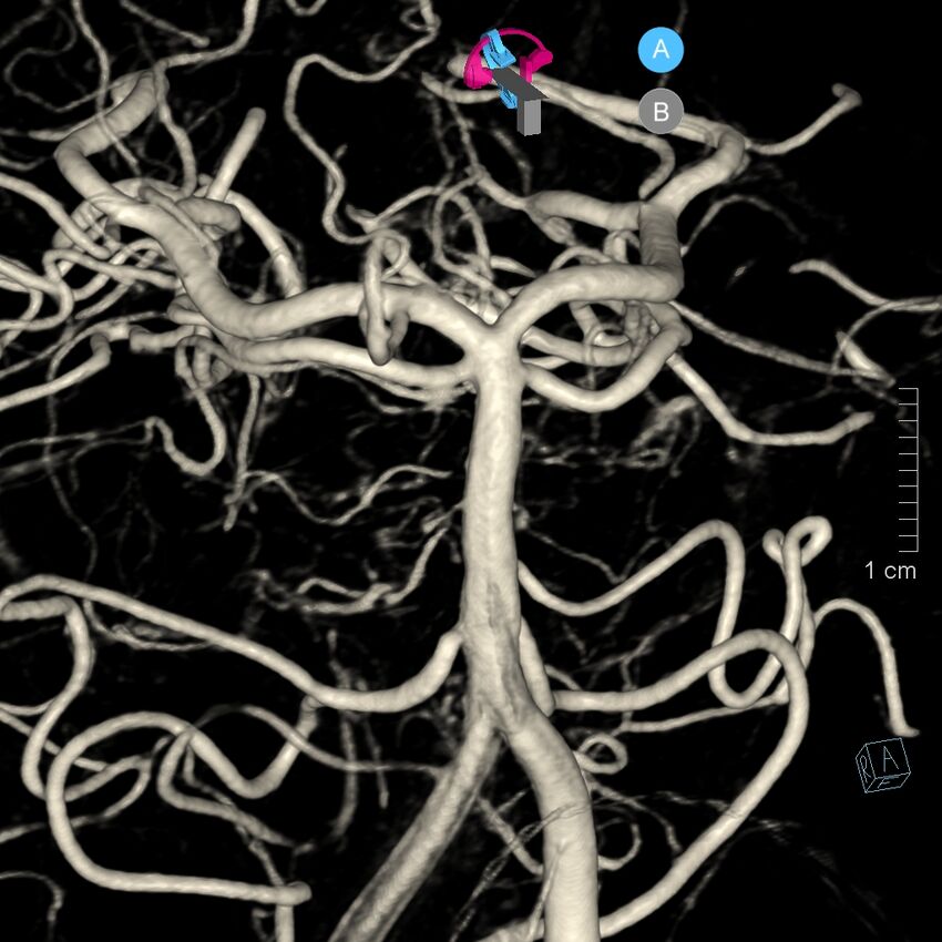 Basilar artery perforator aneurysm (Radiopaedia 82455-97734 3D view left VA 47).jpg