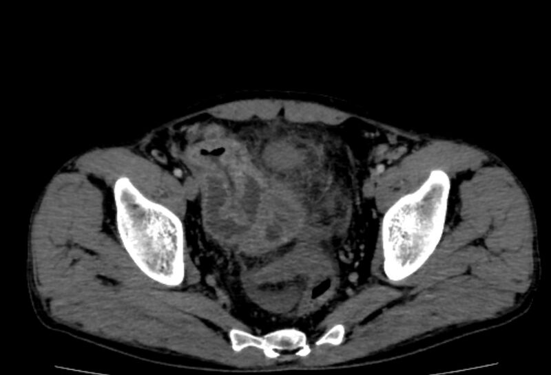 File:Behçet's disease- abdominal vasculitis (Radiopaedia 55955-62570 A 80).jpg