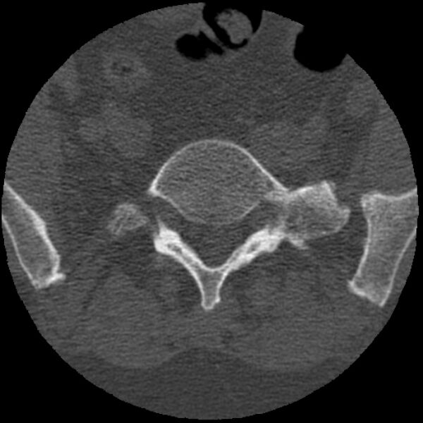 File:Bertolotti syndrome (Radiopaedia 24864-25128 Axial bone window 17).jpg