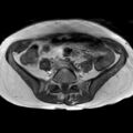 Bicornuate uterus (Radiopaedia 61974-70046 Axial T1 14).jpg