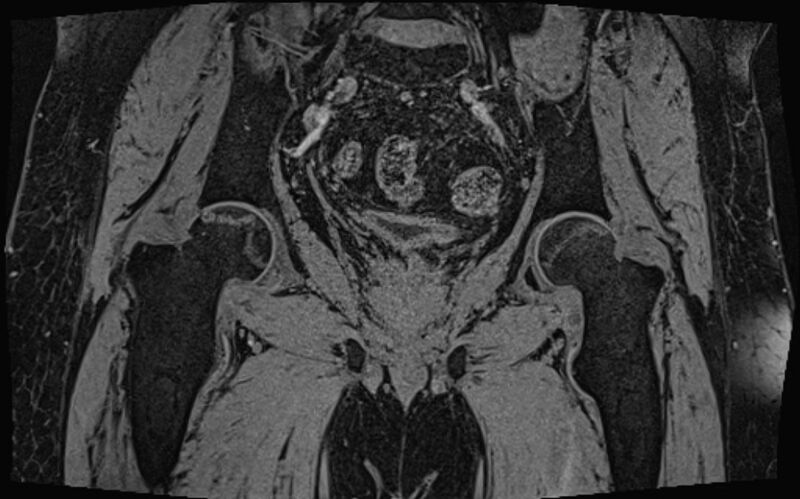 File:Bilateral avascular necrosis of femoral head (Radiopaedia 77116-89078 Coronal T2 we 28).jpg