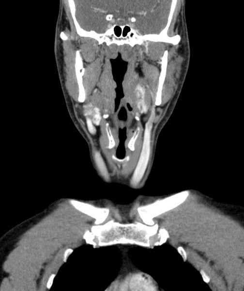 File:Bilateral carotid body tumors (Radiopaedia 52899-58827 B 3).jpg