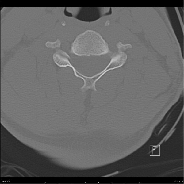 File:Bilateral cervical ribs (Radiopaedia 25868-26017 Axial bone window 27).jpg
