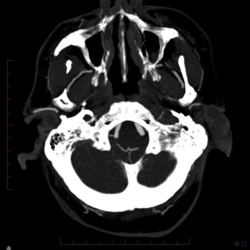 Bilateral chronic common carotid occlusion (Radiopaedia 50849-56362 D 26).jpg