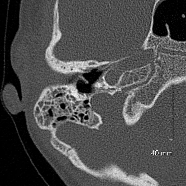 File:Bilateral grommets (Radiopaedia 47710-52404 Axial bone window 29).jpg