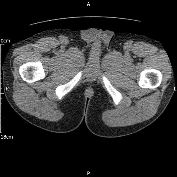File:Bilateral medullary nephrocalcinosis with ureteric calculi (Radiopaedia 71269-81569 Axial non-contrast 148).jpg