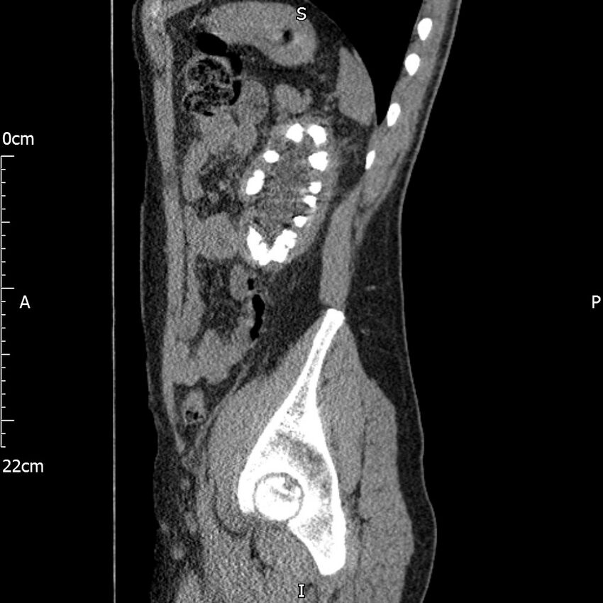 Bilateral medullary nephrocalcinosis with ureteric calculi (Radiopaedia 71269-81569 C 35).jpg