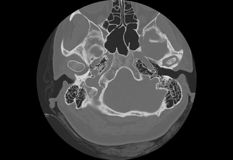 File:Bilateral otospongiosis (Radiopaedia 35447-36940 Axial bone window 14).jpg
