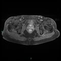 Bilateral ovarian fibroma (Radiopaedia 44568-48293 Axial T1 C+ fat sat 24).jpg