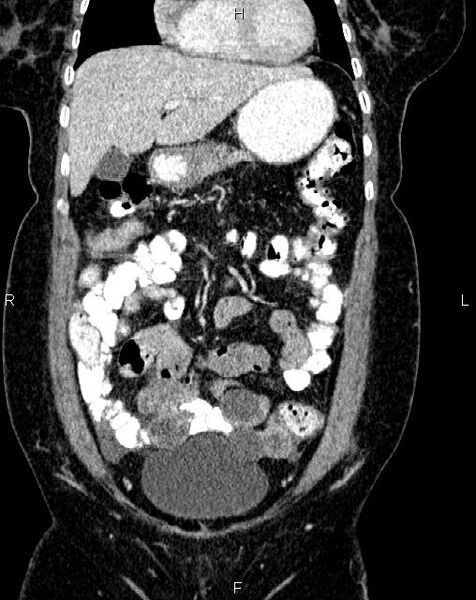 File:Bilateral ovarian serous cystadenocarcinoma (Radiopaedia 86062-101989 D 9).jpg