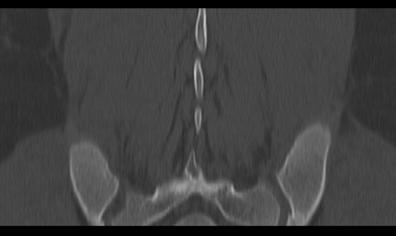 File:Bilateral pars defect (Radiopaedia 26691-26846 Coronal bone window 40).jpg