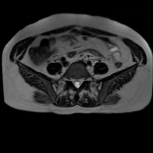 File:Bilateral tubo-ovarian abscesses (Radiopaedia 58635-65829 Axial T2 1).jpg
