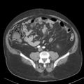 Bladder papillary urothelial carcinoma (Radiopaedia 48119-52951 A 33).png