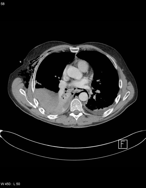 File:Boerhaave syndrome with tension pneumothorax (Radiopaedia 56794-63605 A 28).jpg