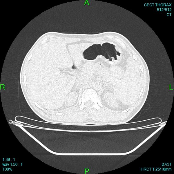 File:Bone metastases from lung carcinoma (Radiopaedia 54703-60937 Axial lung window 27).jpg