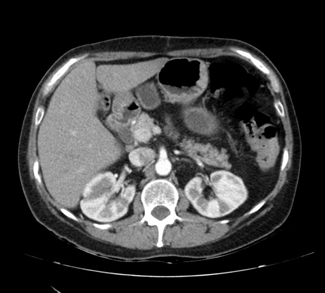 File:Bosniak renal cyst - type IV (Radiopaedia 22929-22953 B 31).jpg