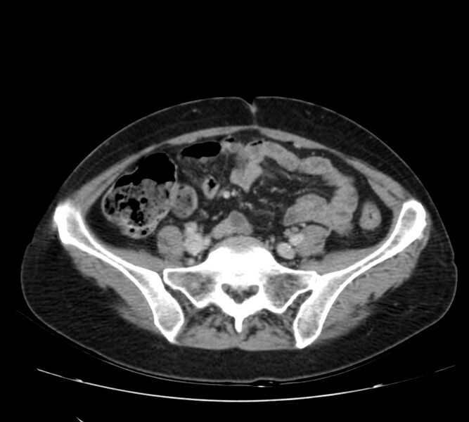 File:Bosniak renal cyst - type IV (Radiopaedia 22929-22953 C 47).jpg