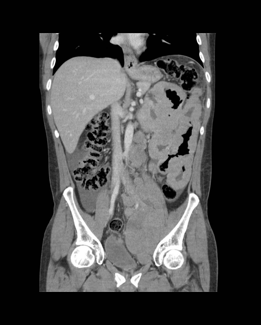 Bowel lymphoma complicated by bleeding after therapy (Radiopaedia 55601-62107 B 36).jpg