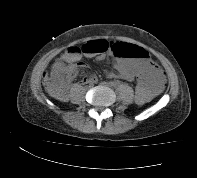 File:Bowel lymphoma complicated by bleeding after therapy (Radiopaedia 55601-62110 Axial non-contrast 53).jpg