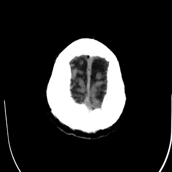 File:Brain Pantopaque remnants (Radiopaedia 78403-91048 Axial non-contrast 84).jpg