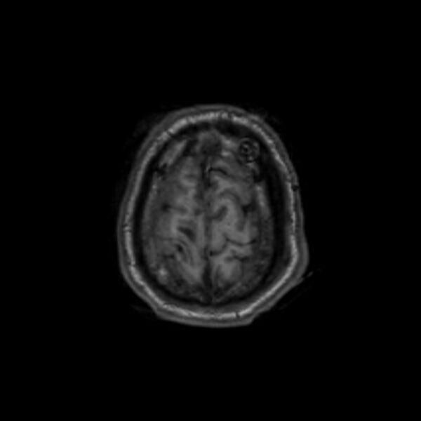 File:Brain abscess complicated by intraventricular rupture and ventriculitis (Radiopaedia 82434-96577 Axial T1 65).jpg