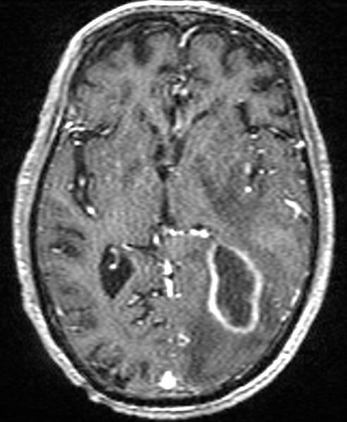 File:Brain abscess with dual rim sign (Radiopaedia 87566-103938 Axial T1 C+ 85).jpg