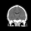 Brain death (Radiopaedia 78597-91360 Coronal non-contrast 41).jpg