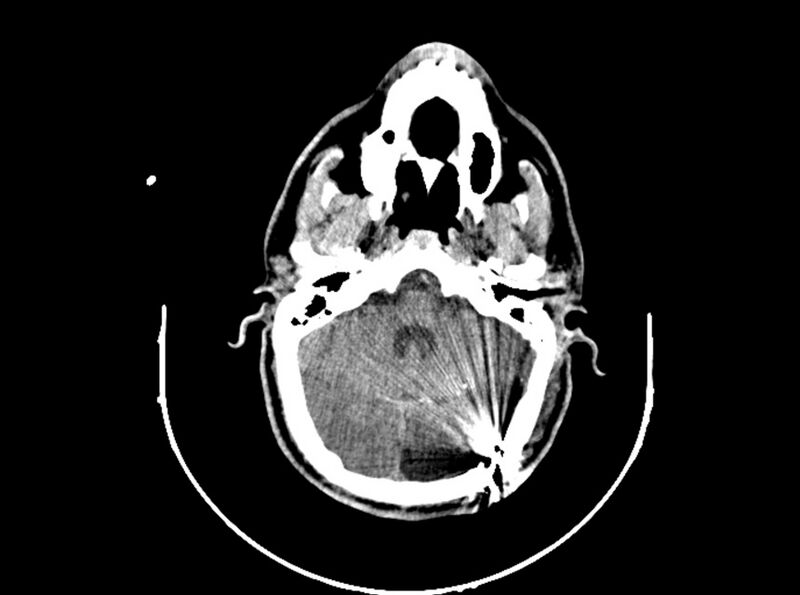 File:Brain injury by firearm projectile (Radiopaedia 82068-96088 A 86).jpg