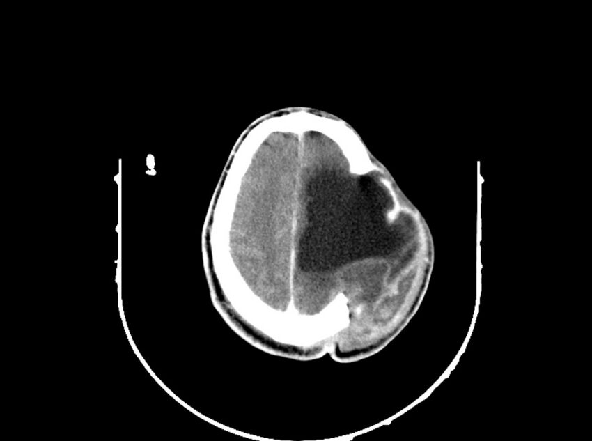 Brain injury by firearm projectile (Radiopaedia 82068-96088 B 174).jpg