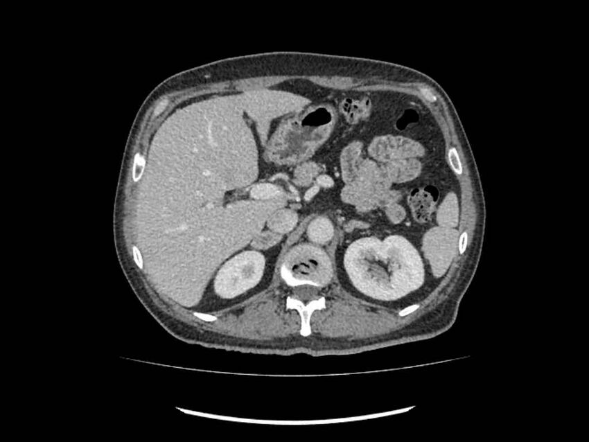 Brain metastases from renal cell carcinoma (Radiopaedia 42222-45328 B 43).jpg
