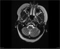 Brainstem glioma (Radiopaedia 21819-21775 Axial T2 6).jpg