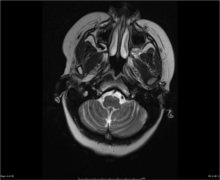 File:Brainstem glioma (Radiopaedia 21819-21775 Axial T2 6).jpg