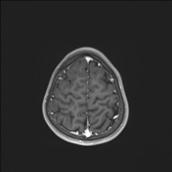 File:Brainstem glioma (Radiopaedia 70548-80674 Axial T1 C+ 133).jpg