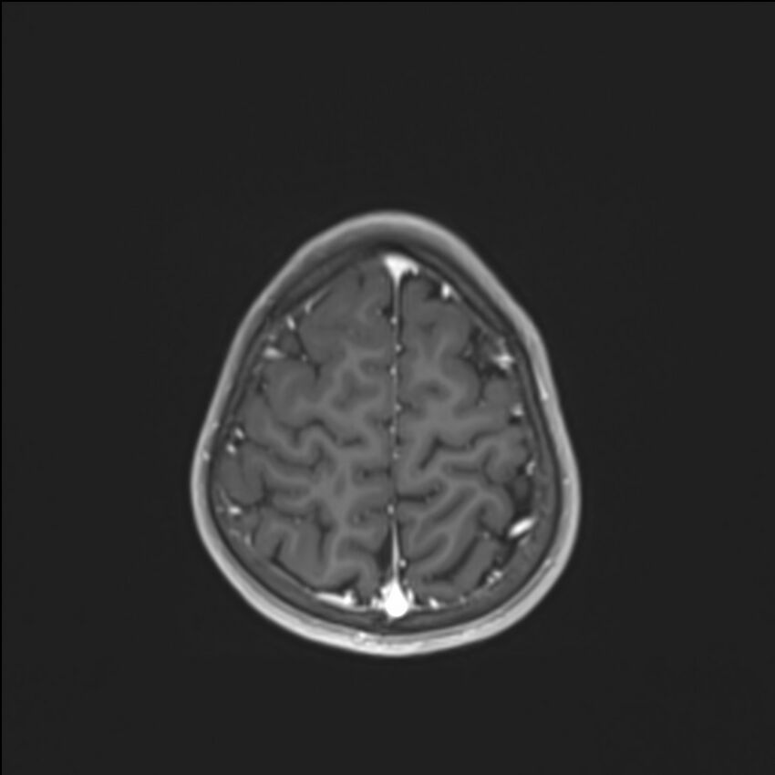 Brainstem glioma (Radiopaedia 70548-80674 Axial T1 C+ 133).jpg