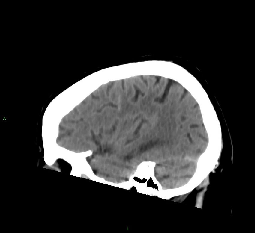 Brainstem hemorrhage (Radiopaedia 58794-66028 C 39).jpg